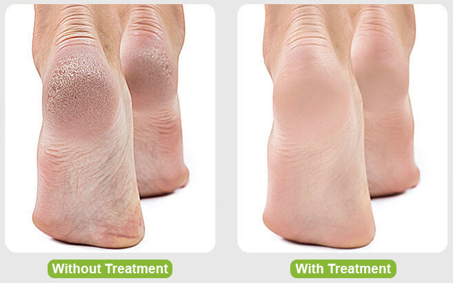 SoftFeet™ Elektrische Fußfeile