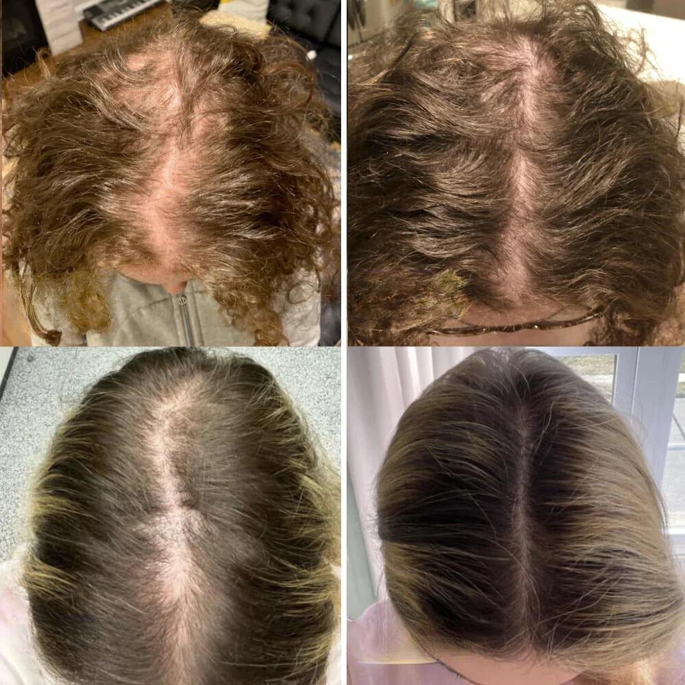 HairGrow™ - Vogany Natürliches Haarwuchsöl (50% RABATT)