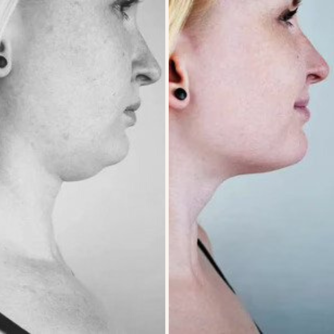 50% RABATT | TheraSpa®️ | EMS Vface Lymphatisches Massagegerät