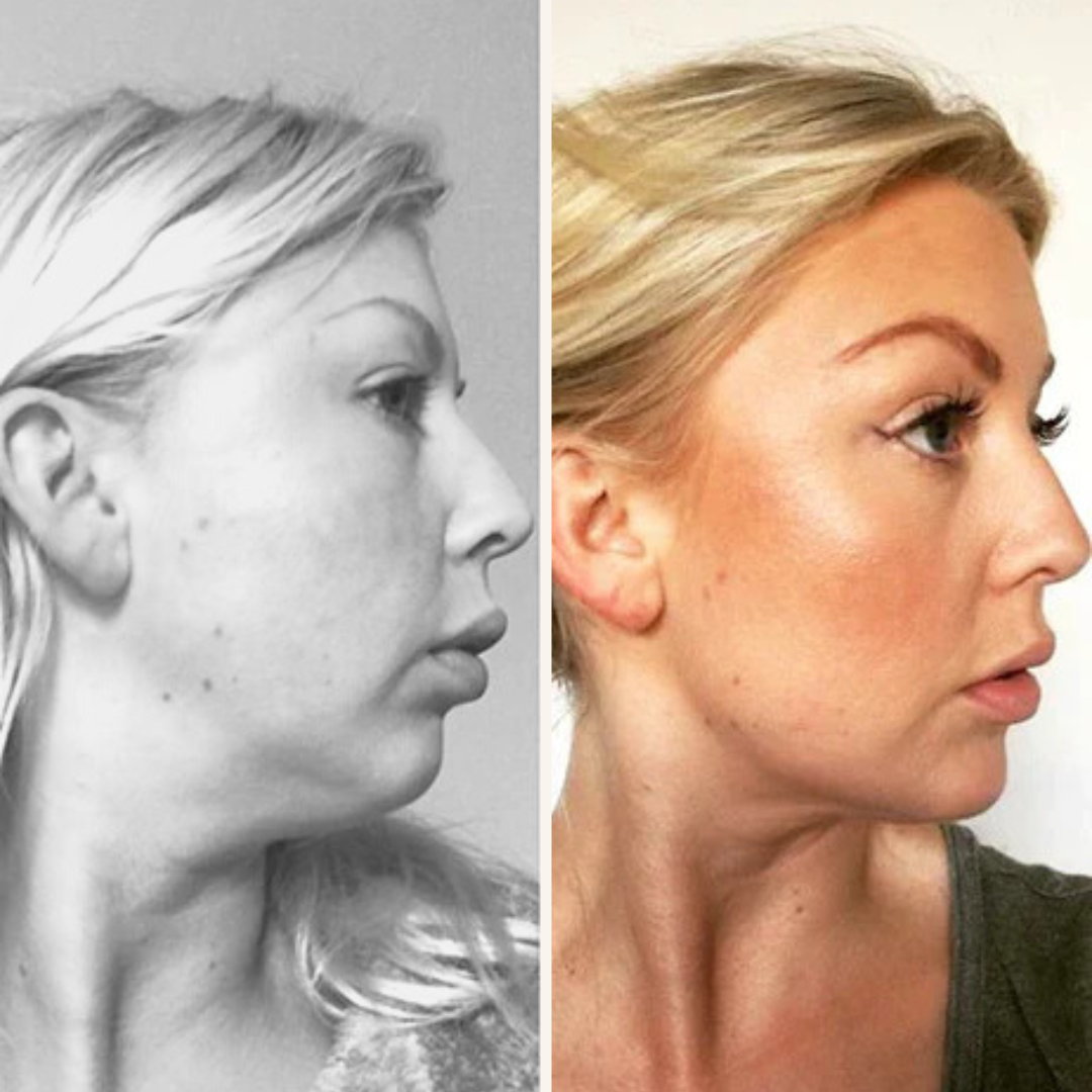 50% RABATT | TheraSpa®️ | EMS Vface Lymphatisches Massagegerät