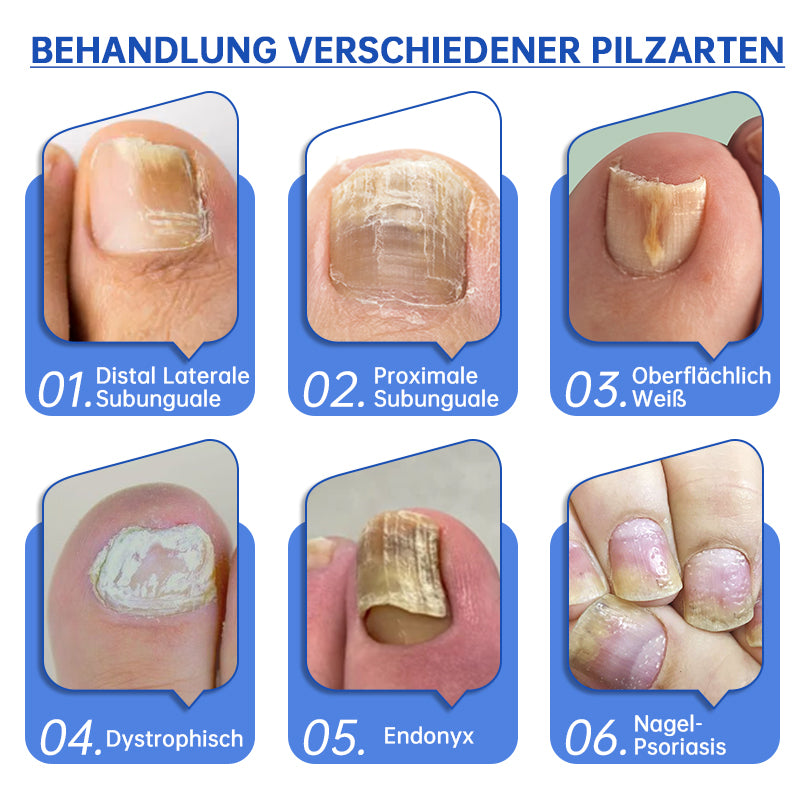 NailCure™ - Nagelpilz-Laserbehandlung Lösung (50% RABATT)